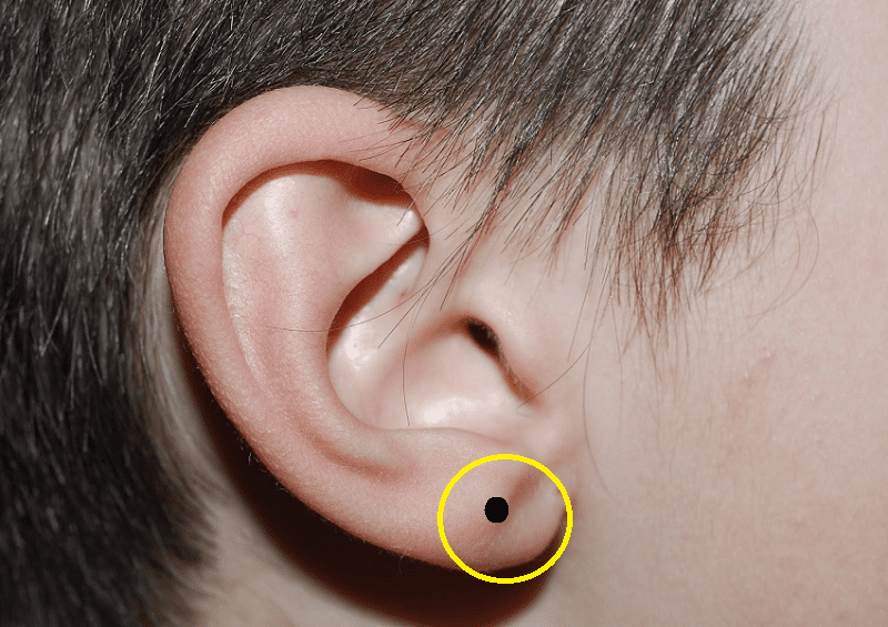 Giải mã nốt ruồi ở tai, nốt ruồi ở dái tai