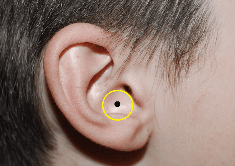 Nốt ruồi ở tai có ý nghĩa gì, nốt ruồi ở trong tai