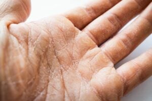 nguyên nhân khiến da tay bị khô là gì