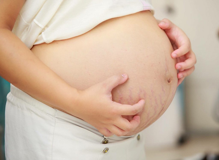 Tình trạng rạn da khi mang thai thường xuất hiện ở giai đoạn cuối thai kỳ